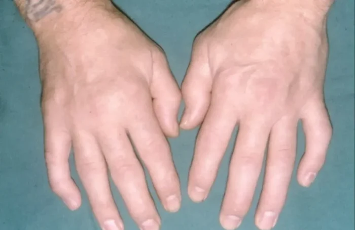 التهاب المفاصل الصدفي