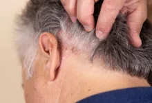 Photo of ما هو علاج الأكزيما الدهنية في فروة الرأس؟