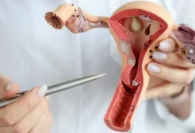 Photo of ما هي طرق علاج تكيس المبايض للمتزوجة؟