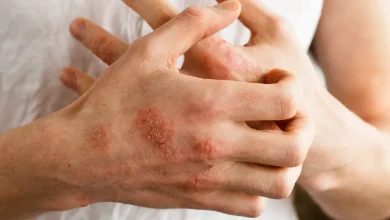 Photo of علاج أكزيما اليدين في المنزل | طرق طبيعية لعلاج الأكزيما