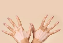 علاج البهاق