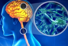 علاج التصلب المتعدد