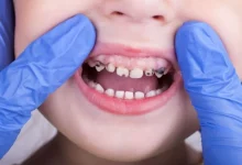 Photo of علاج تسوس الاسنان عند الاطفال 3 سنوات .. الأسباب والأعراض وطرق العلاج الفعالة