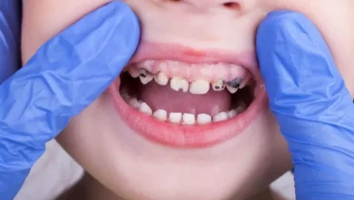 Photo of علاج تسوس الاسنان عند الاطفال 3 سنوات .. الأسباب والأعراض وطرق العلاج الفعالة