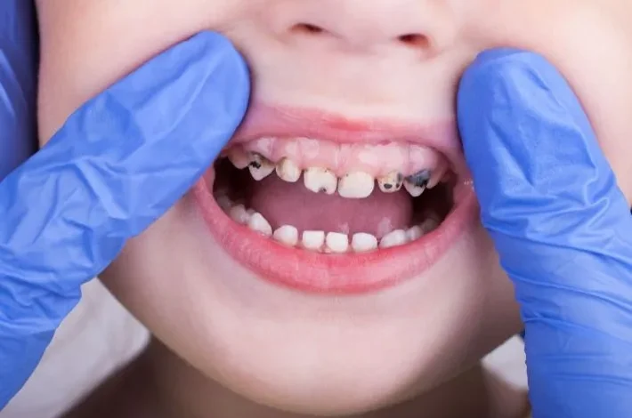علاج تسوس الاسنان