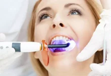 علاج لتبيض الاسنان