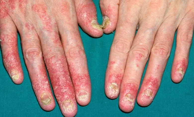 التهاب المفاصل الصدفي