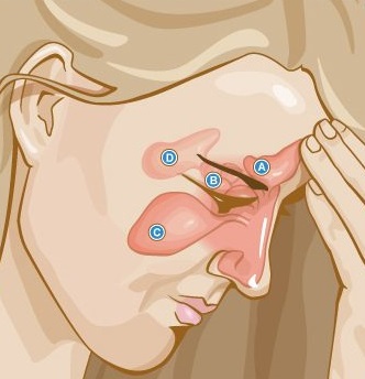 علاج التهاب الجيوب الأنفية