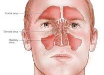 علاج صداع الجيوب الانفية المزمن